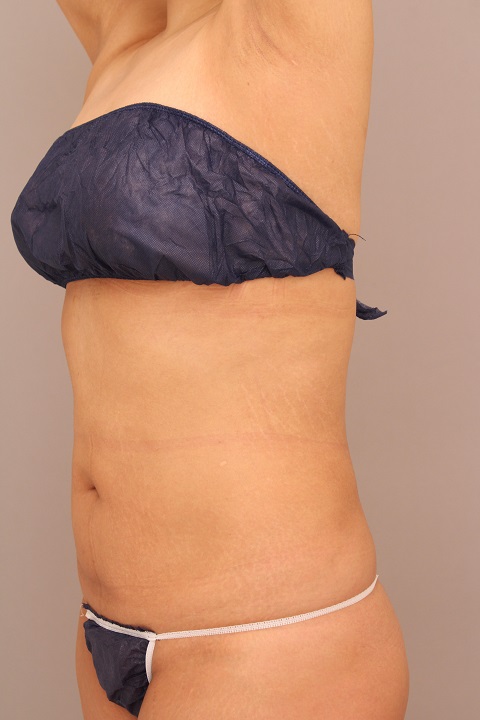 お腹・腰の脂肪吸引　術後３ヵ月の経過　