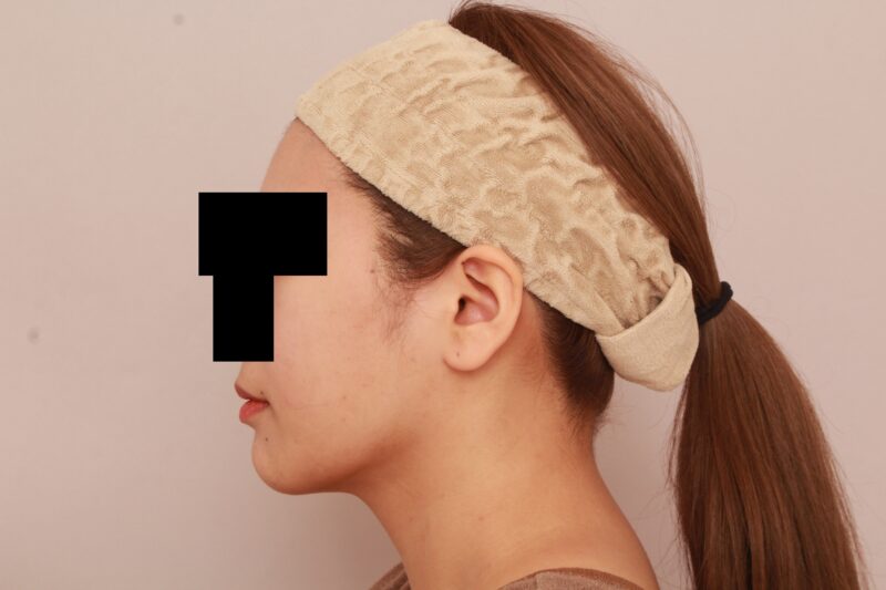 ほほ顎脂肪吸引でまっすます美人さんに♡