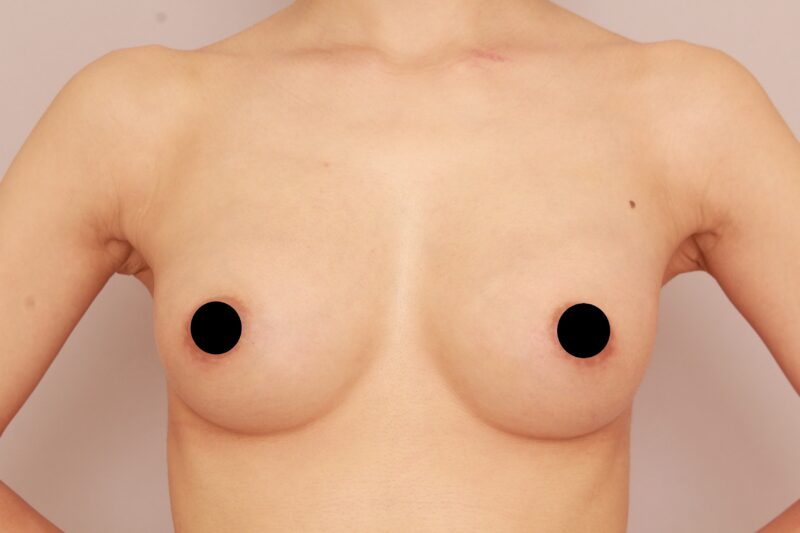 コンデンスリッチ豊胸でふっくら美バストに♡