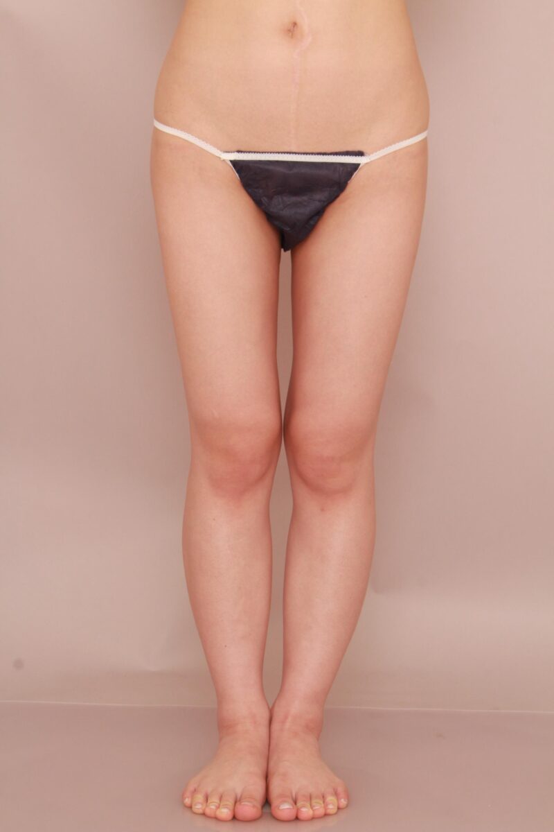 劇的変化!!太もも全周、お尻の脂肪吸引半年後♡