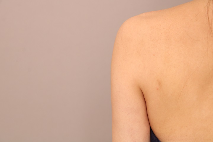 二の腕・肩の脂肪吸引　術後3か月の経過