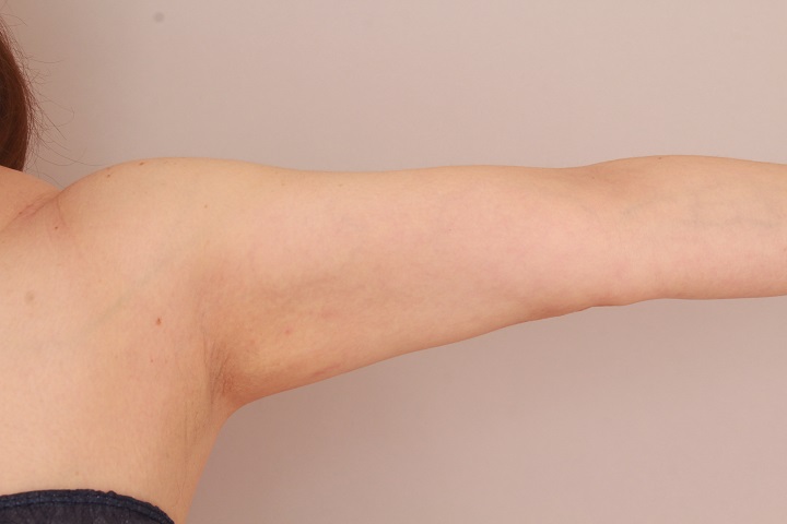 二の腕・肩の脂肪吸引　術後3か月の経過