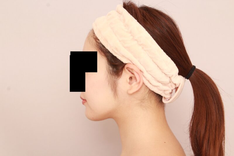 ほほ顎脂肪吸引で目指せ!石原さとみフェイス♡