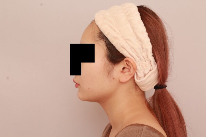 ほほ顎脂肪吸引ですでにシュッとした1か月後♡