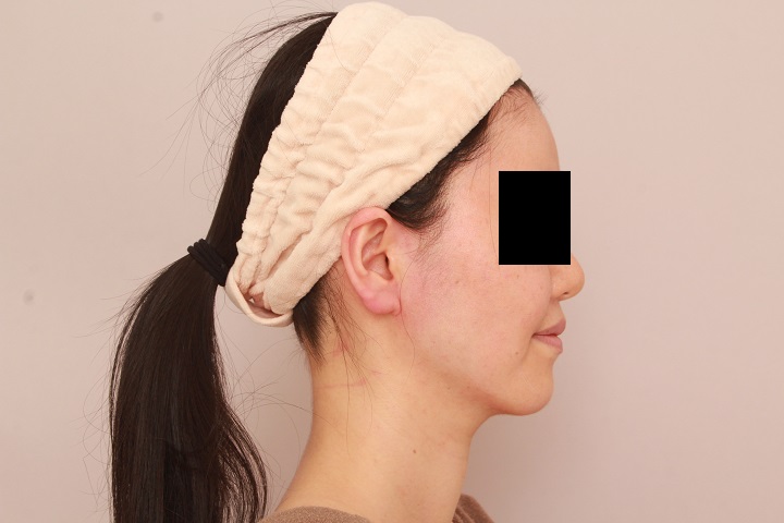 お顔の脂肪吸引　術後6カ月の経過