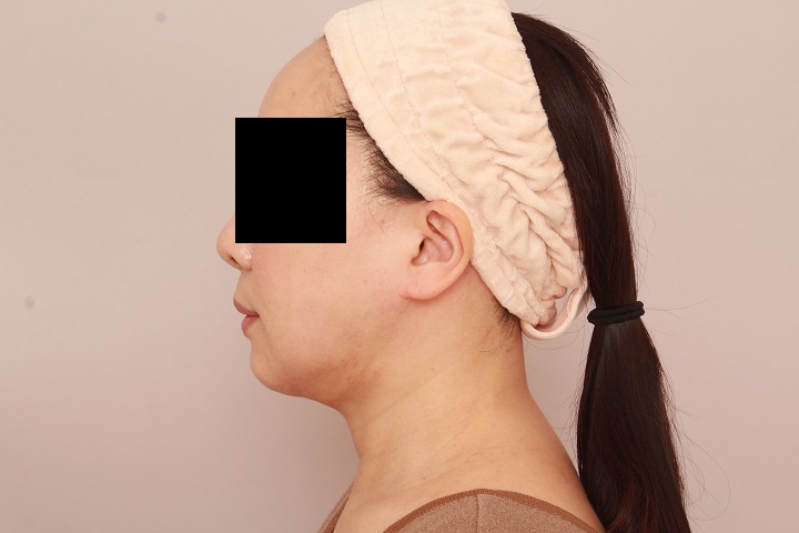 お顔の脂肪吸引　術後1ヵ月の経過