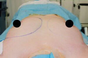 抜去後のバスト