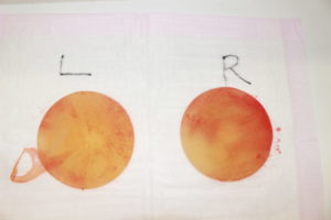 抜去したシリコンバッグ