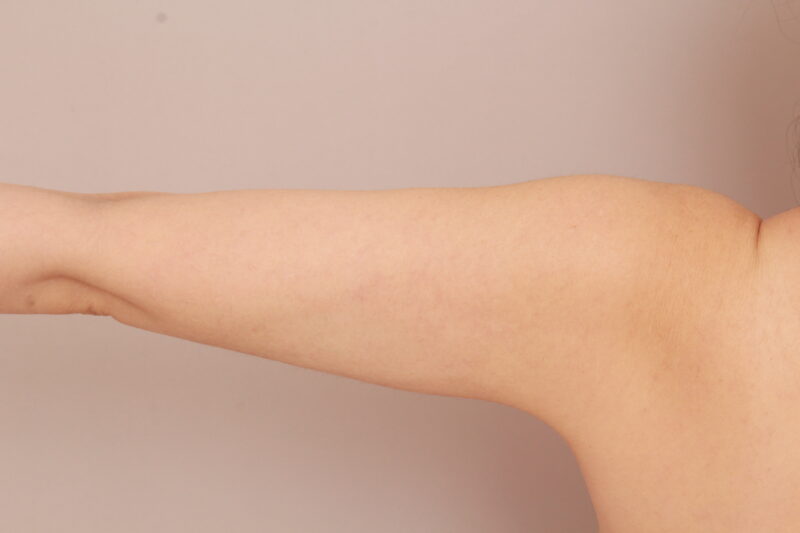 二の腕、肩の脂肪吸引3か月後
