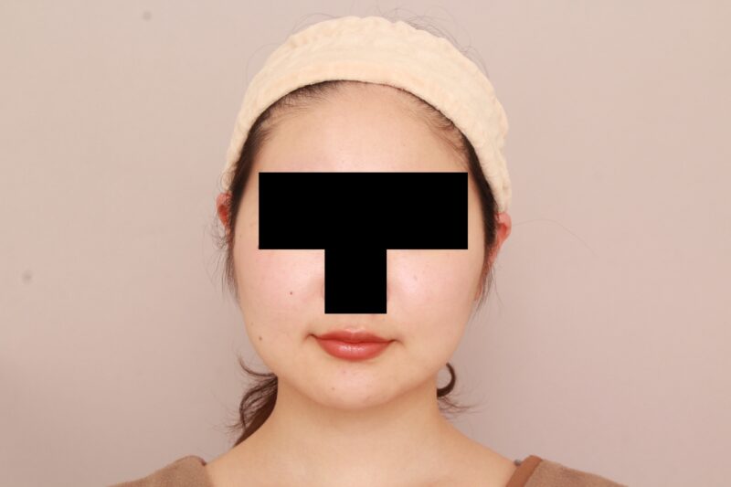 ほほ顎脂肪吸引でまっすますぐぐっと美人さんに♡