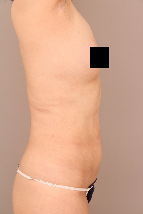 お腹・腰の脂肪吸引　術後3か月の経過