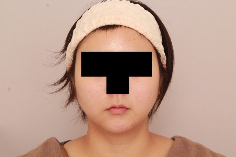 ほほ顎脂肪吸引でまっすます美人さんに♡3か月後