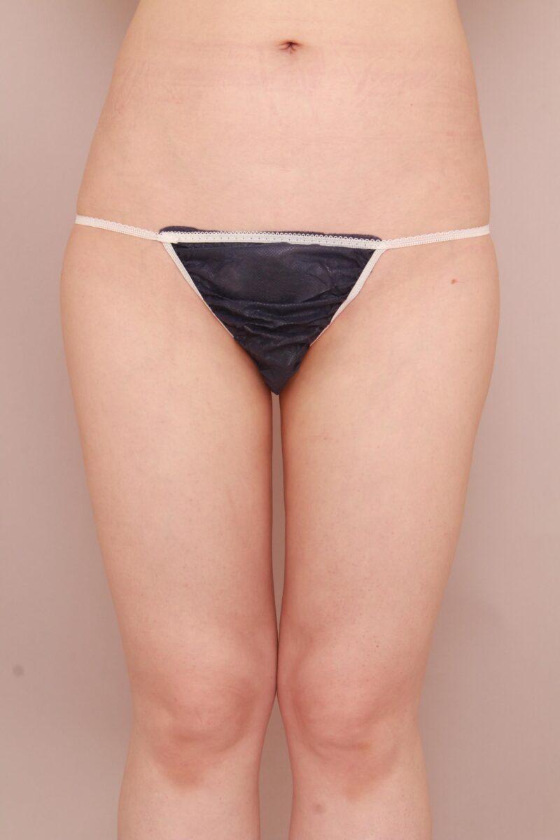 太もも全周、お尻の脂肪吸引でコンプレックスにさようなら♡