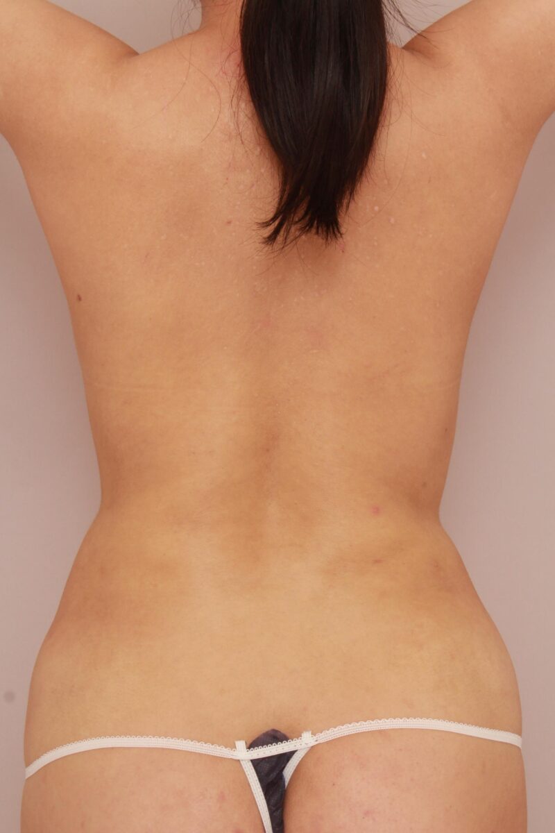 みんなで目指そう!峰不二子♡お腹全体、胸下、腰の脂肪吸引半年後