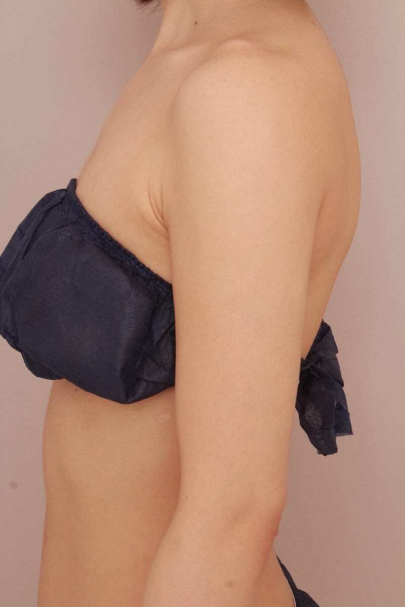 二の腕、肩の脂肪吸引でラインを変えよう♡6か月後