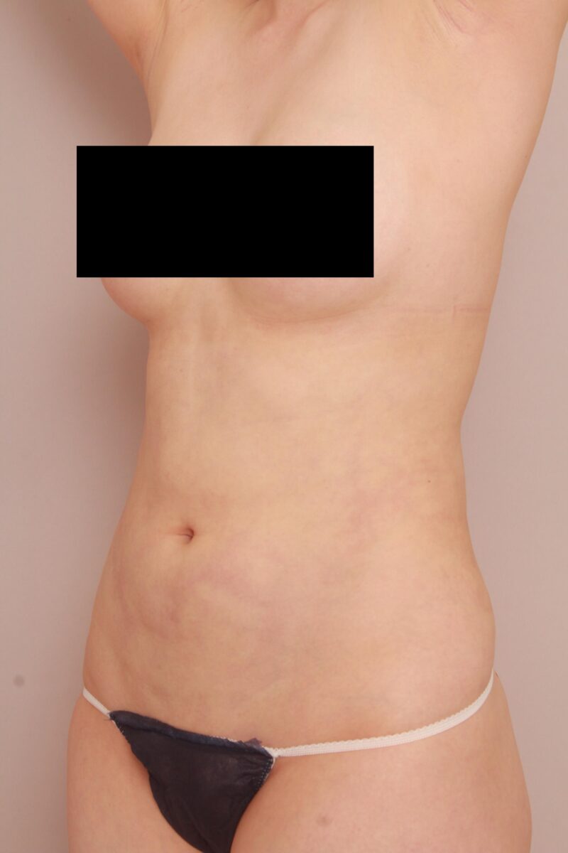 みんなで目指そう峰不二子♡お腹全体、胸下、腰の脂肪吸引半年後