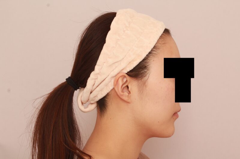 輪郭を整えてプリンセスフェイス♡モニター様3か月後