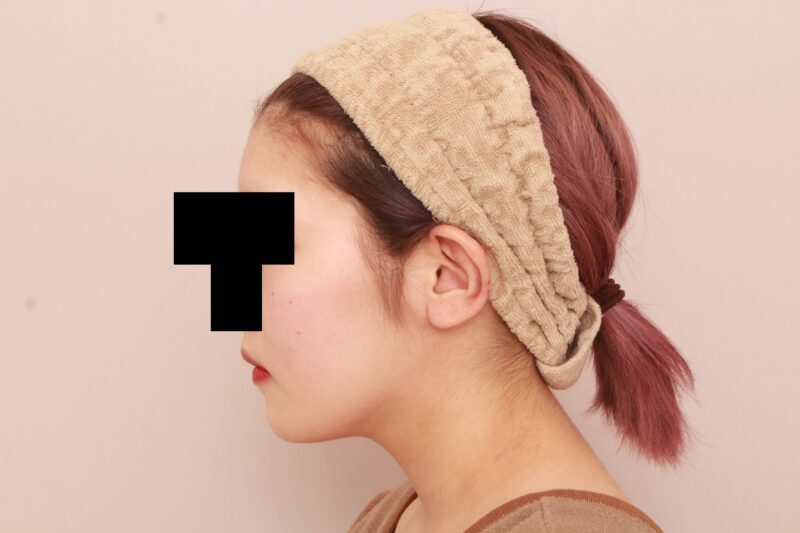 ほほ顎脂肪吸引3か月後♡