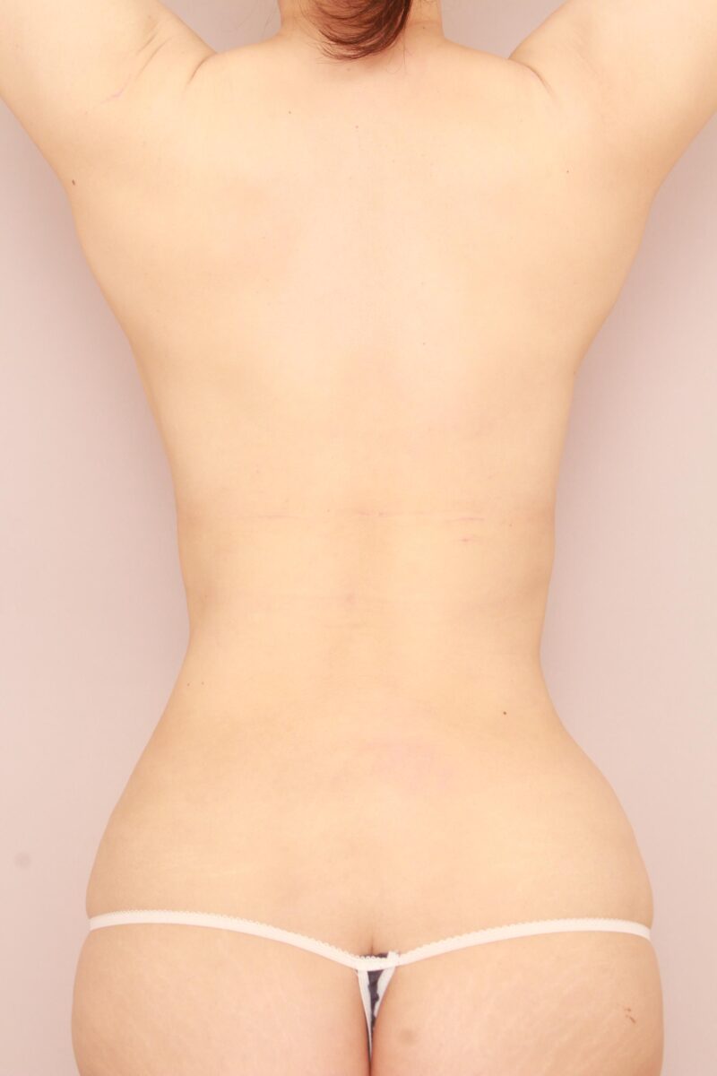 40代のお腹全体胸下腰の脂肪吸引3か月後♡