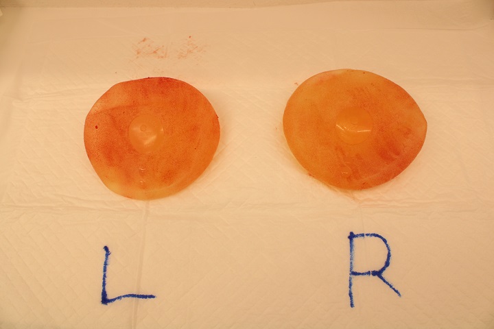 シリコンバッグ除去+コンデンスリッチ豊胸 術後3ヵ月の経過