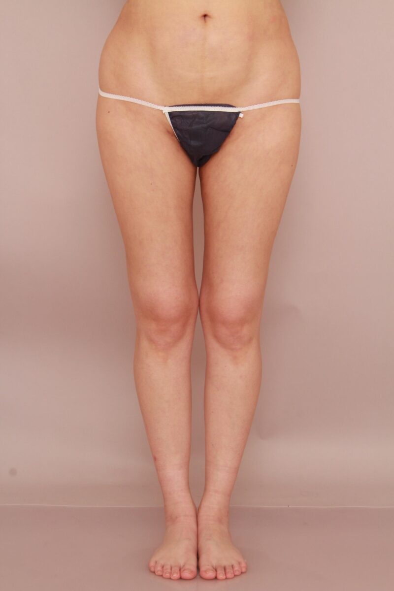 シルエットの印象を変えよう!!太もも全周、お尻の脂肪吸引半年後