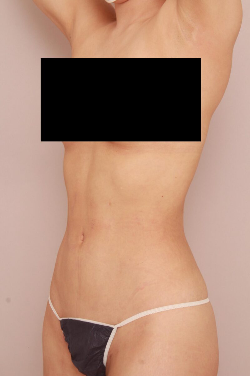 みんなで目指そう峰不二子♡お腹全体胸下腰の脂肪吸引半年後♡