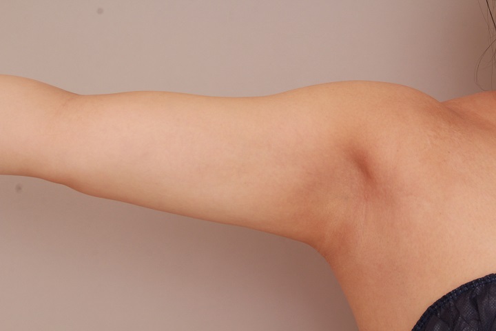 二の腕・肩の脂肪吸引 術後6ヵ月の経過