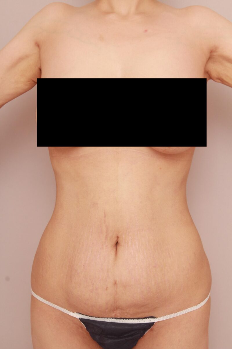 皮膚のたるみが強いタイプのモニター様のお腹全体胸下腰の脂肪吸引3か月後♡