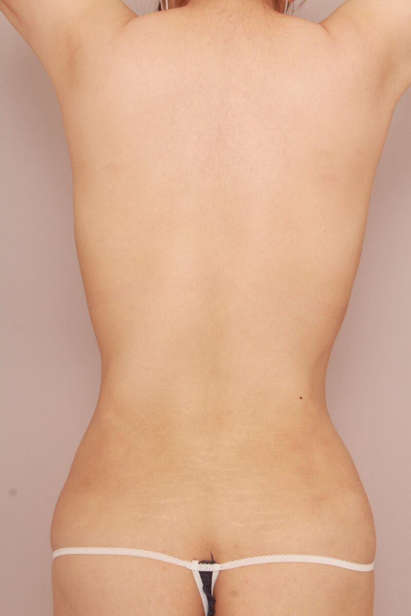 昨日のモニター様の背面の変化♡3か月後