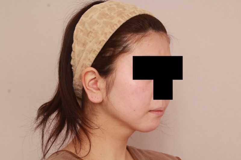 ほほ顎脂肪吸引のモニター様6か月後♡