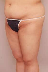 太ももの脂肪吸引1ヶ月後（BMI高めの方）