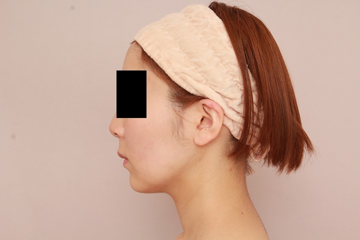 お顔の脂肪吸引 術後6ヵ月の経過