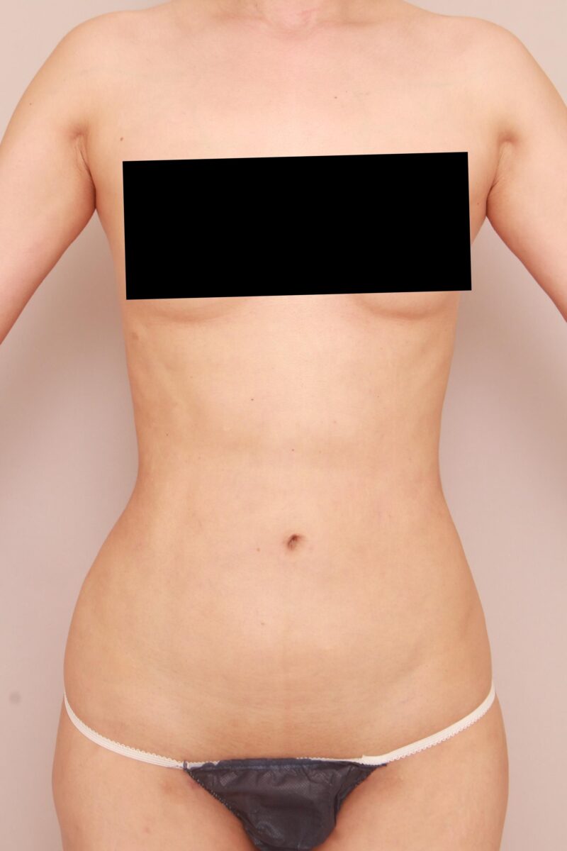 みんなで目指そう峰不二子♡やせ型の方のお腹全体胸下腰の脂肪吸引3か月後