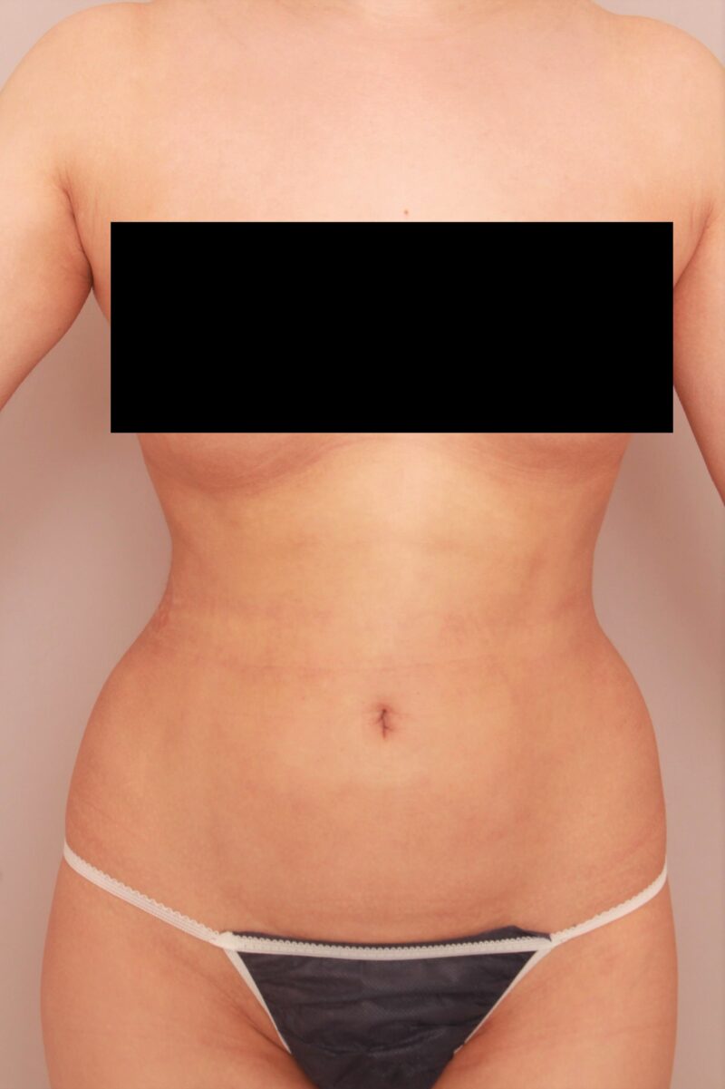 みんなで目指そう峰不二子♡お腹全体胸下腰の脂肪吸引3か月後