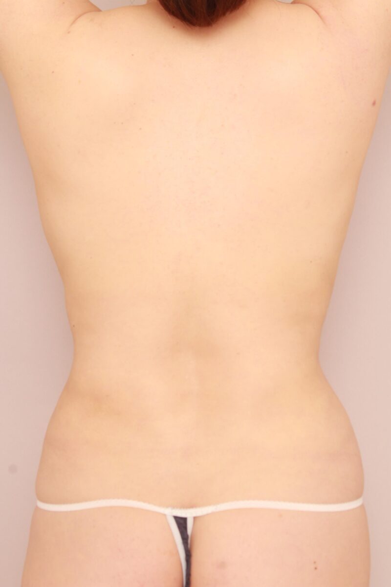 みんなで目指そう峰不二子♡お腹全体胸下腰の脂肪吸引とコンデンスリッチ豊胸のモニター様3か月後