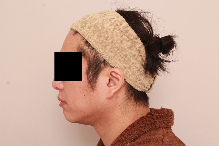 男性のお顔の脂肪吸引 術後3ヵ月の経過