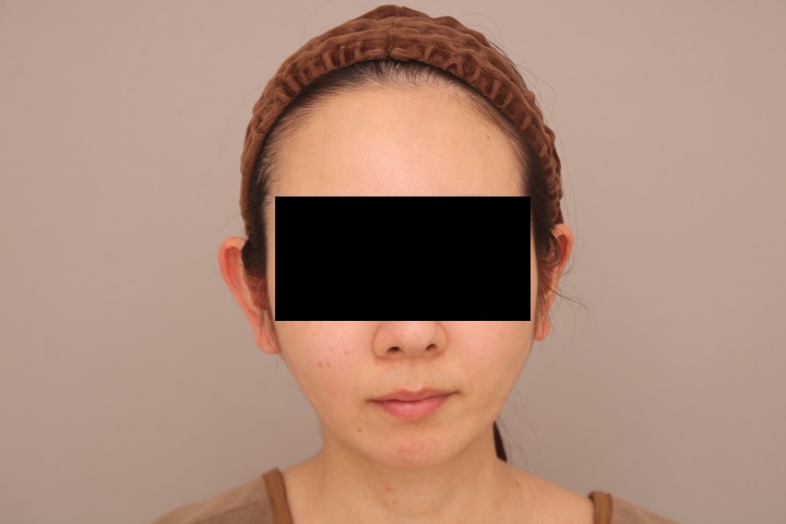 お顔の脂肪吸引 術後3ヵ月の経過