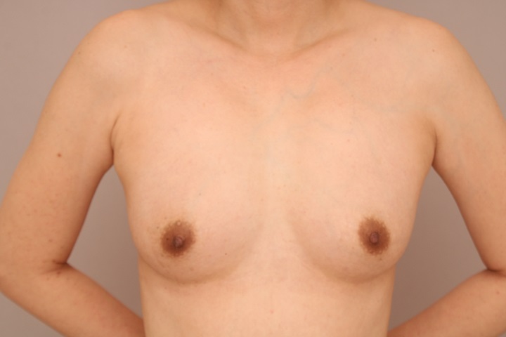 コンデンスリッチ豊胸 術後3ヵ月の経過