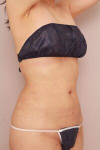 お腹の脂肪吸引術後1ヶ月