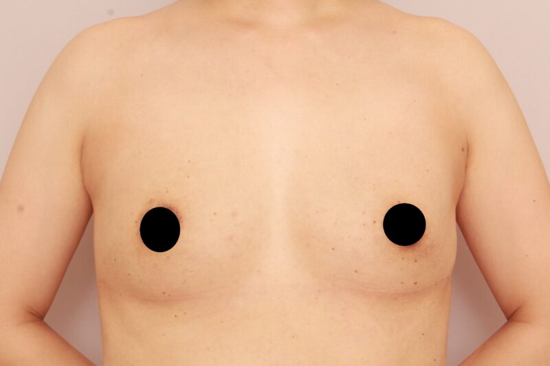 バストの若返り♪コンデンスリッチ豊胸と乳頭縮小1か月後