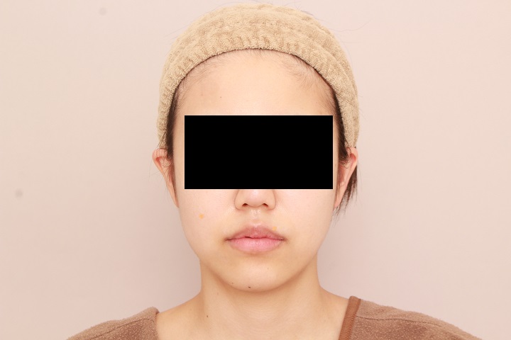 お顔の脂肪吸引 術後3ヵ月の経過