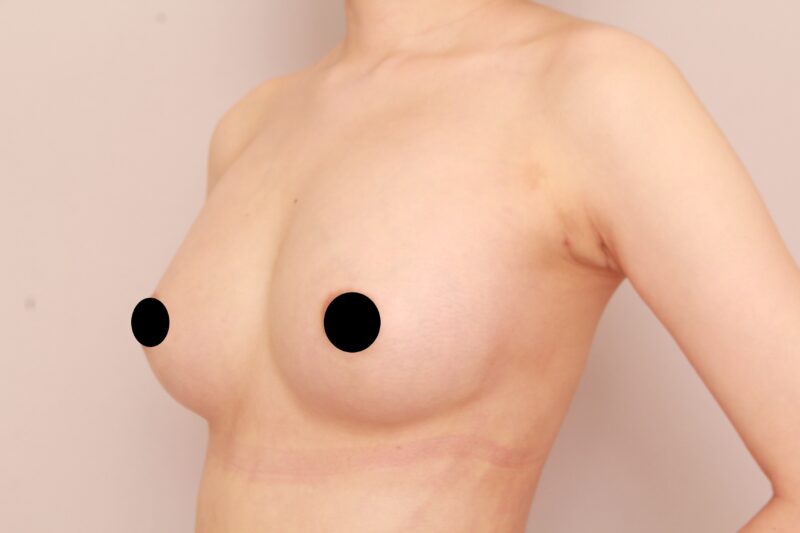 コンデンスリッチ豊胸でリアルバービー人形に♡