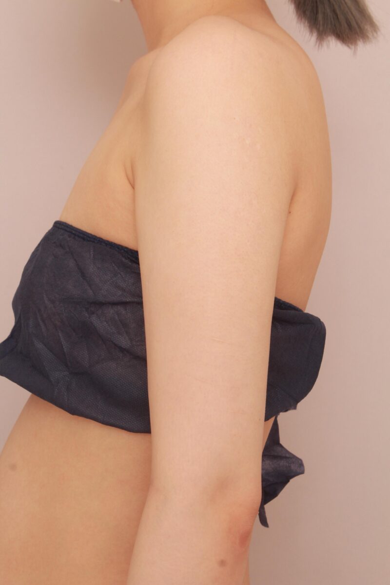 二の腕、肩の脂肪吸引半年後♡