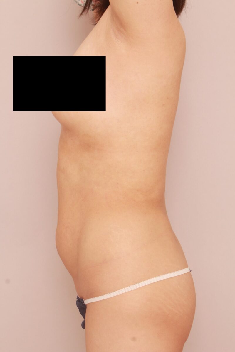 みんなで目指そう峰不二子♡お腹全体胸下腰の脂肪吸引半年後♡