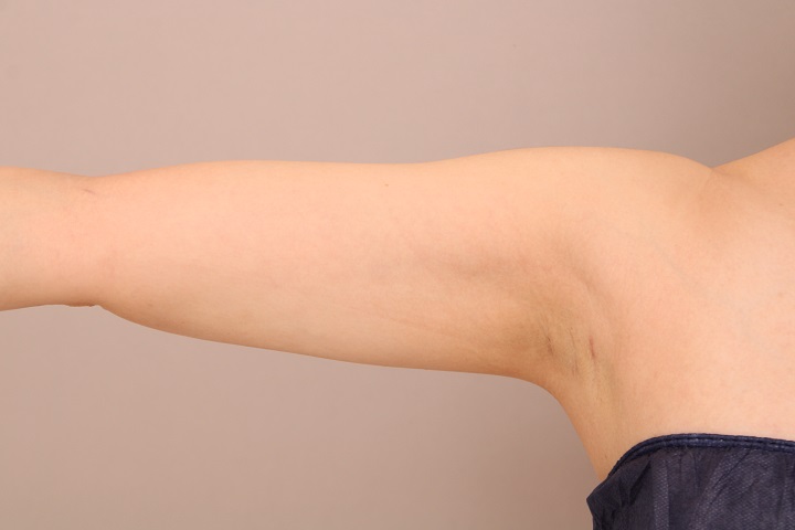 二の腕・肩の脂肪吸引 術後3ヵ月の経過