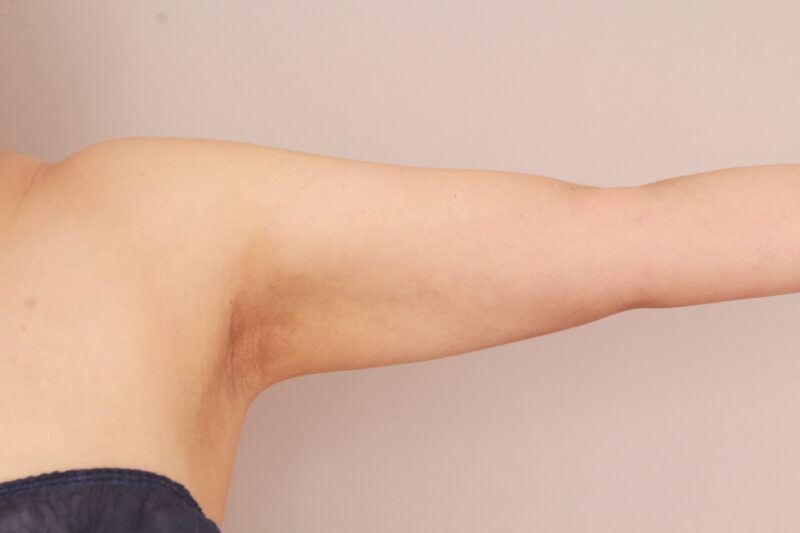 二の腕、肩の脂肪吸引のモニター様3か月後