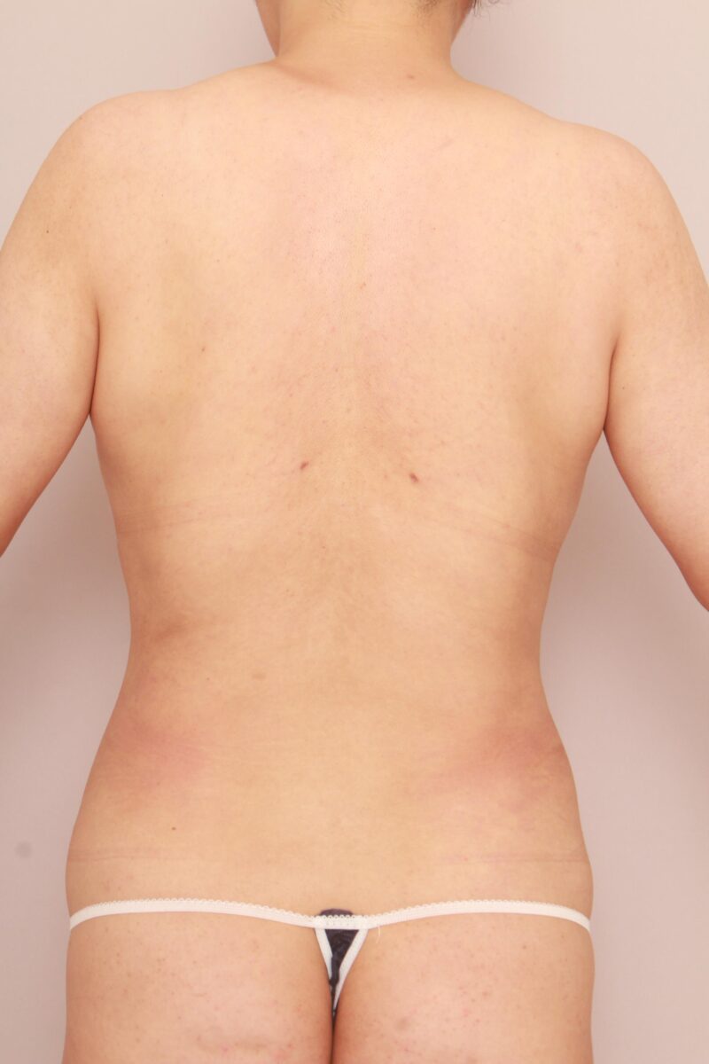 肩甲骨上下、腰の脂肪吸引3か月後