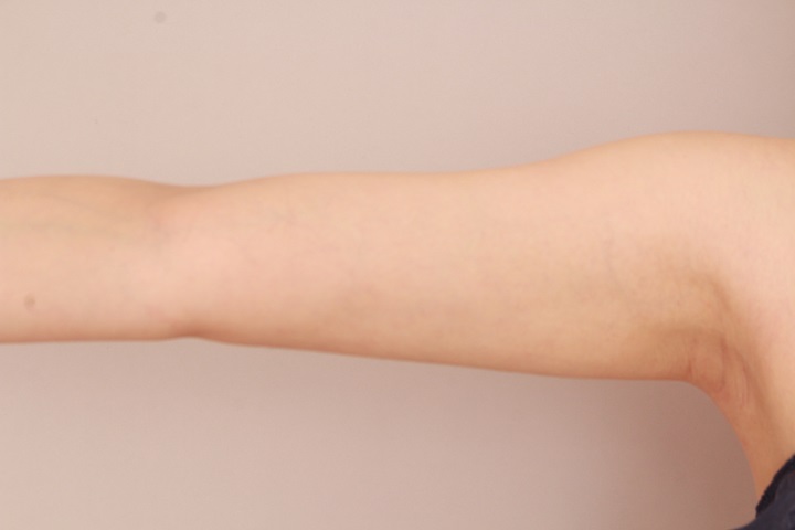 二の腕・肩の脂肪吸引 術後3カ月の経過