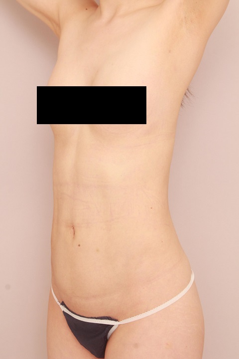 お腹・腰の脂肪吸引　術後６ヵ月の経過
