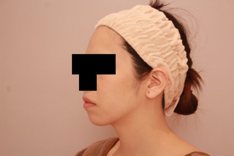 ほほ顎脂肪吸引半年後の変化♡